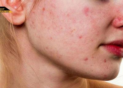 صابون گیاهی سیندرلا، بهترین درمان جوش و لک های پوستی